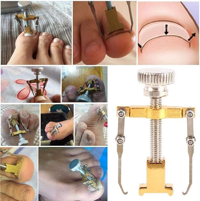SOLLER Ingrown Toenail Correction Toe Clamp Stainless Steel Health Tool